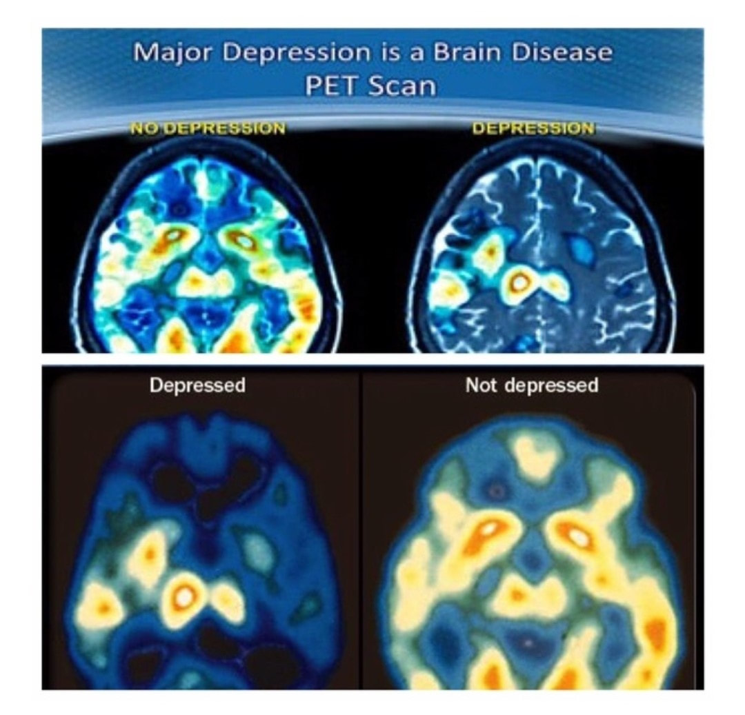 Depression Brain Diagram